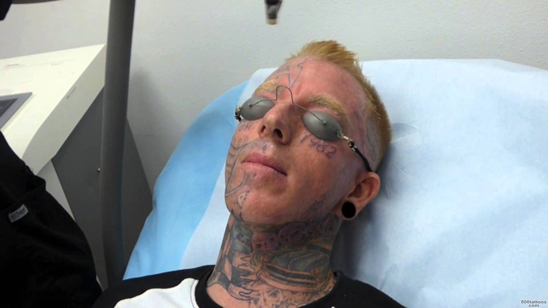 Incredible! Face Tattoo Removal   3rd Treatment at Dr. Tattoff ..._16