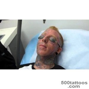 Incredible! Face Tattoo Removal   3rd Treatment at Dr Tattoff _16