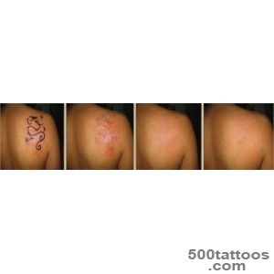 Tattoo Removal Doctors Techniques Clinics   Dr Suruchi Puri_50