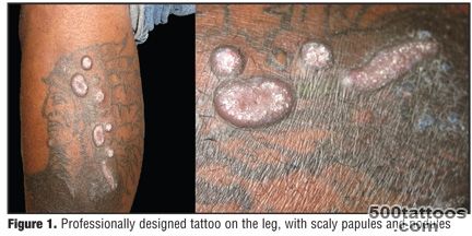 Multiple Eruptive Keratoacanthomas Arising in a Tattoo  JCAD ..._37