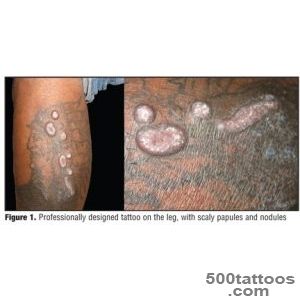 Multiple Eruptive Keratoacanthomas Arising in a Tattoo  JCAD _37
