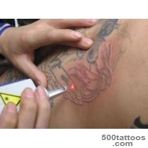 Tattoo removal can be first step in ensuring job search success _49