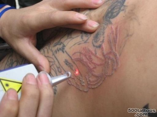 Tattoo removal can be first step in ensuring job search success ..._49