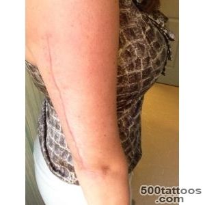Darlin#39 Darla on Twitter Considers tattoo to cover up broken arm _31
