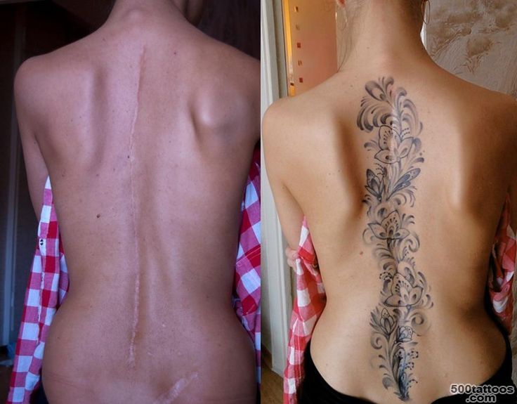 scoliosis+scar+cover+up+tattoos  Scoliosis Surgery Scar Tattoo ..._8